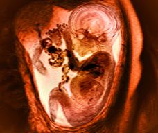 37周后,大约有3%的胎儿是臀位的